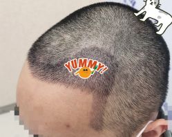 -大麦微针植发全国连锁