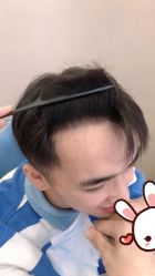 点击看大图 -大麦微针植发丨全国连锁