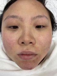 -蕾特恩专业祛痘