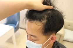 -大麦微针植发丨全国连锁