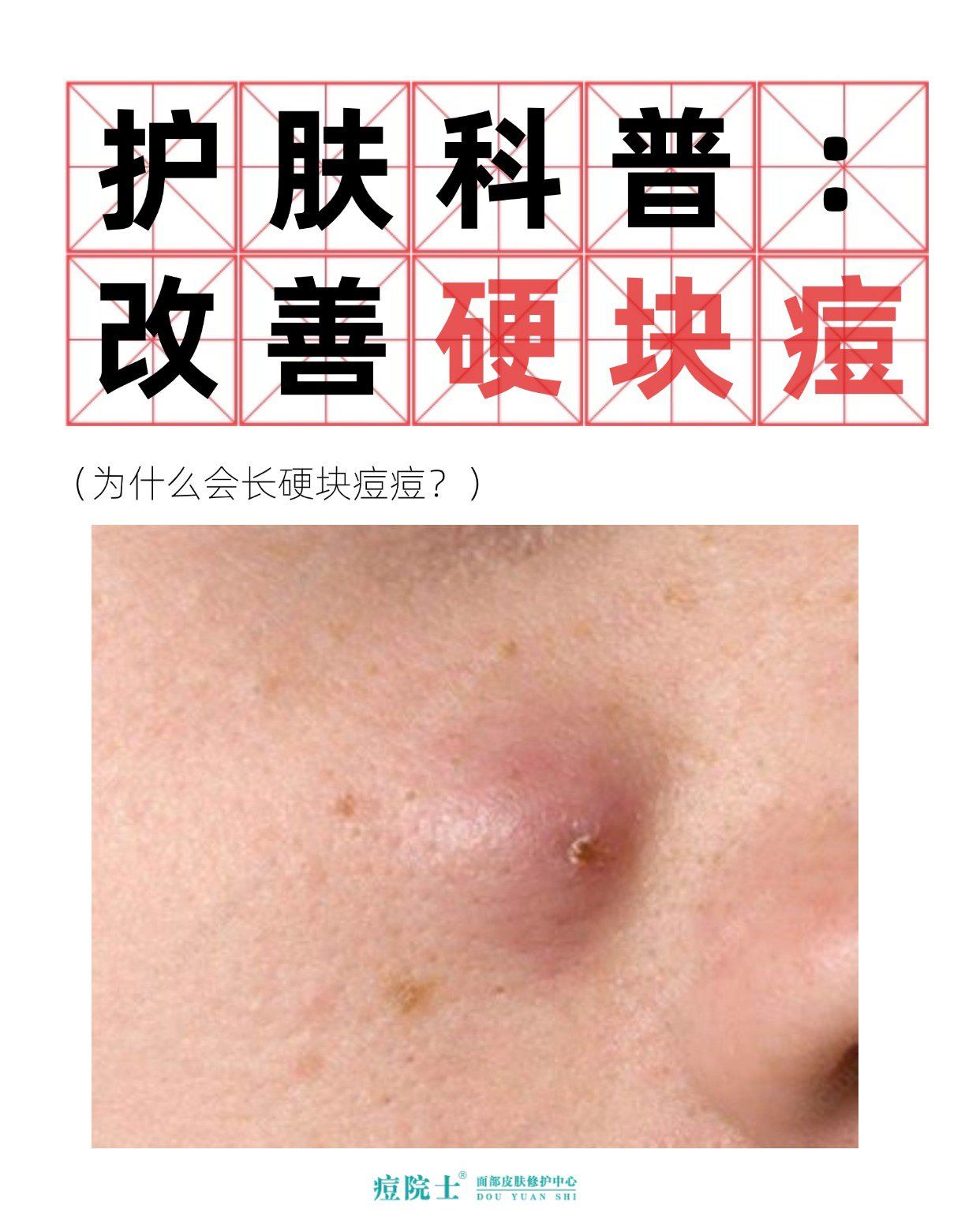 痘痘里面有硬块怎么办?