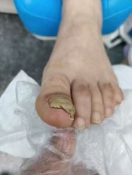 -德哥灰指甲脚气甲沟炎跖疣护理
