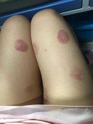 -苗塑堂减肥艾灸