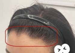 -大麦微针植发全国连锁