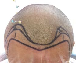 -大麦微针植发全国连锁