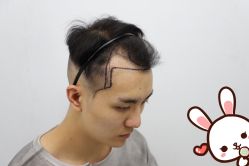 -大麦微针植发丨全国连锁