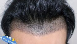 -大麦微针植发丨全国连锁