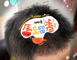 -大麦微针植发全国连锁