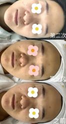 点击看大图 -凡碧诗毛孔清洁收细