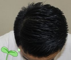 -大麦微针植发丨全国连锁