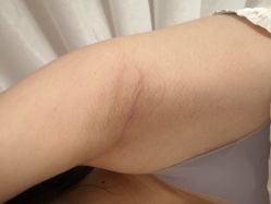 -薇兰专业脱毛连锁机构