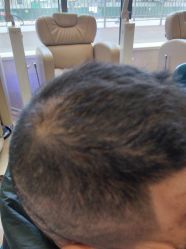 -碧莲盛·不剃发植发