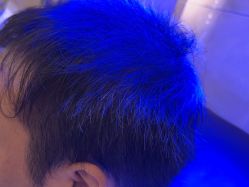 -碧莲盛·不剃发植发