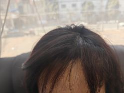 -碧莲盛·不剃发植发