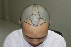 -大麦微针植发丨全国连锁