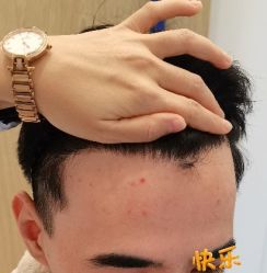 -大麦微针植发丨全国连锁