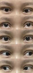 体验后-广州美莱医疗美容医院