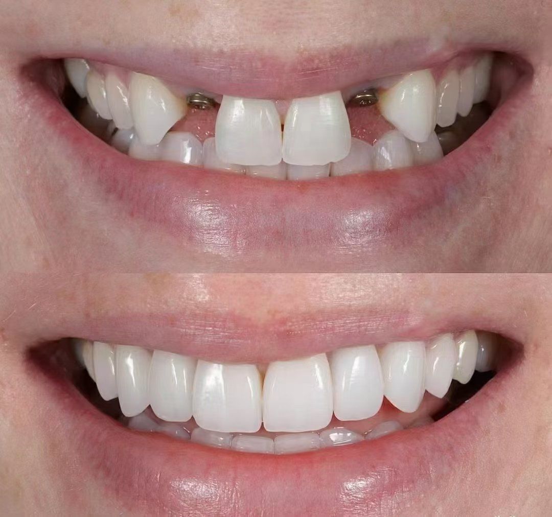 前牙缺失修复,最佳修复方式便是种植修复