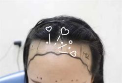 -大麦微针植发全国连锁