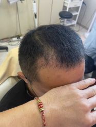 -大麦微针植发丨全国连锁
