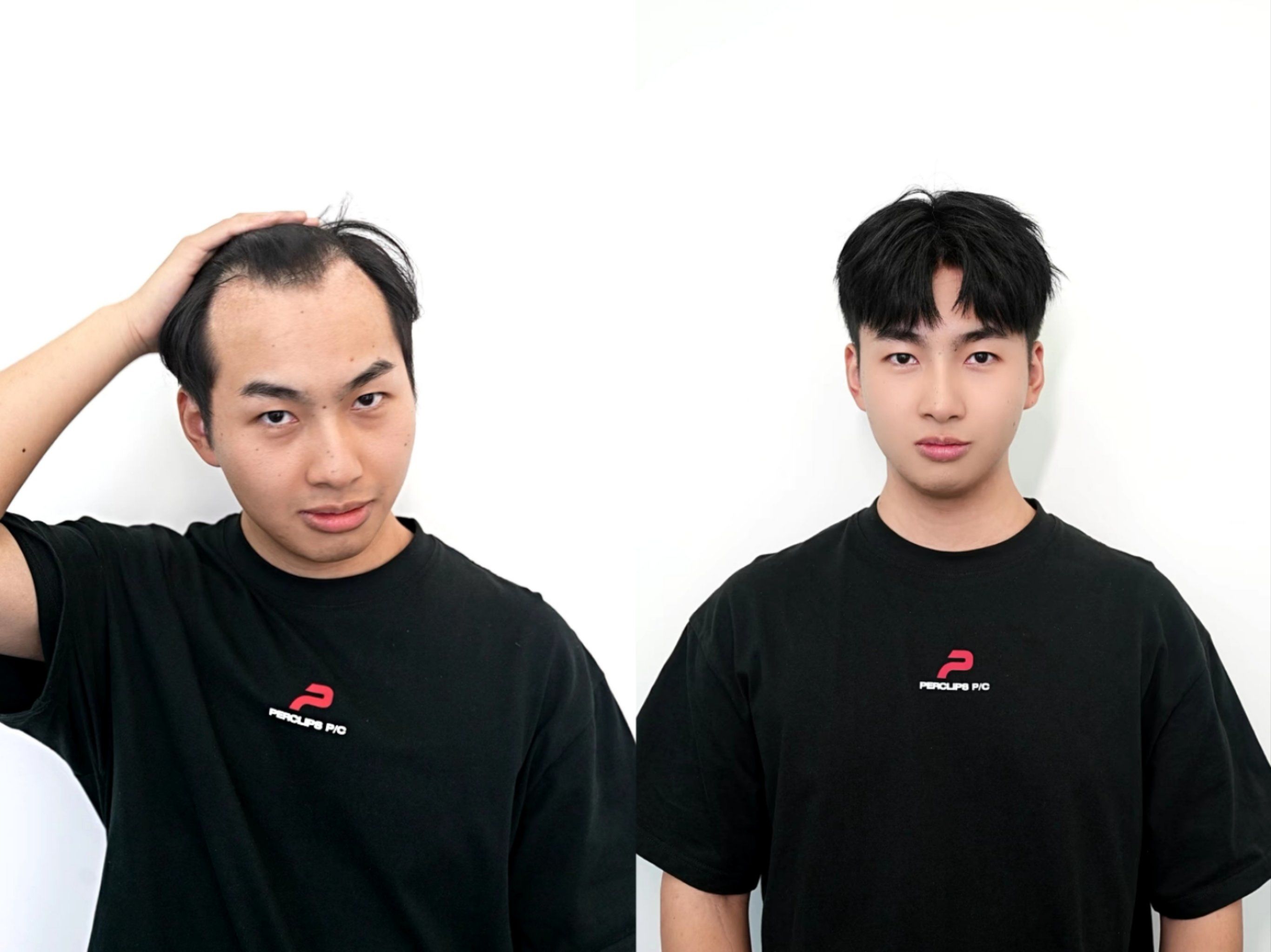 发际线后移直接选择假发