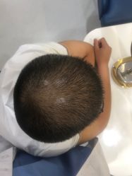 -大麦微针植发全国连锁