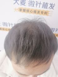 -大麦微针植发全国连锁
