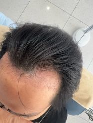 -大麦微针植发丨全国连锁