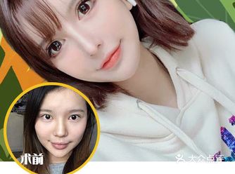 【鼻整形案例】全面部改造后，她从“老阿姨”变身“小姐姐”！