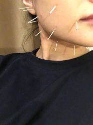 -肥三针腧穴瘦身馆
