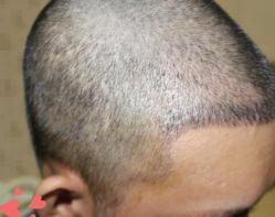 -大麦微针植发丨全国连锁