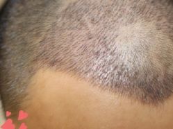 -大麦微针植发丨全国连锁