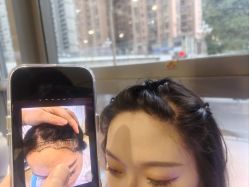 -碧莲盛·不剃发植发