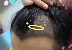 -大麦微针植发全国连锁