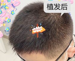 -大麦微针植发全国连锁