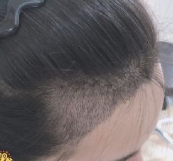 -大麦微针植发丨全国连锁