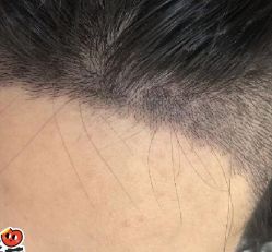 -大麦微针植发丨全国连锁