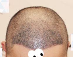 -大麦微针植发全国连锁