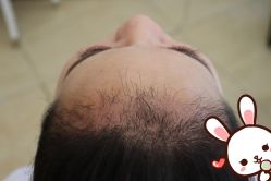 -大麦微针植发丨全国连锁