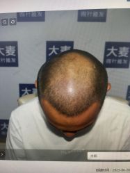 体验后-大麦微针植发丨全国连锁