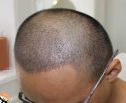 -大麦微针植发丨全国连锁