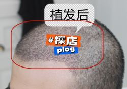 -大麦微针植发全国连锁