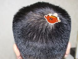 -大麦微针植发丨全国连锁