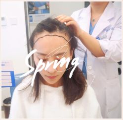 -大麦微针植发全国连锁