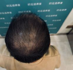 -碧莲盛·不剃发植发