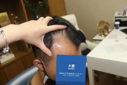 -大麦微针植发全国连锁