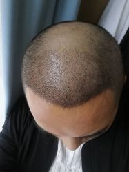 点击看大图 -大麦微针植发丨全国连锁