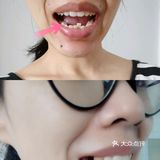 牙齿矫正‖如何判断自己需不需要拔牙
