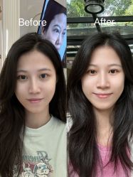 -广州健丽·去眼袋医疗美容机构