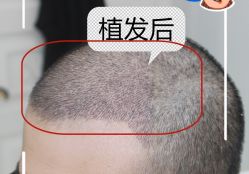 -大麦微针植发全国连锁